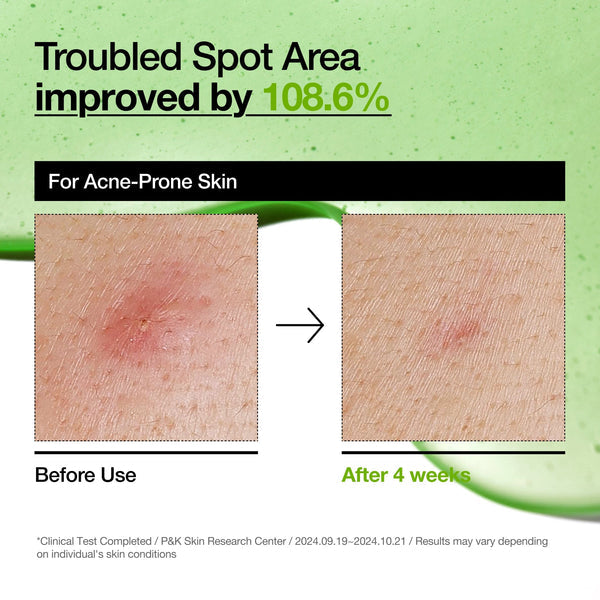 Anua Azelaic Acid 10 Hyaluron Redness Soothing Serum — image 7