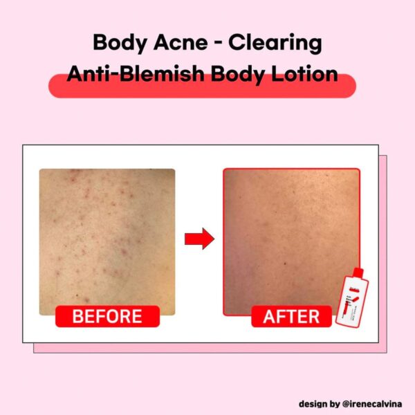 TIAM Anti Blemish Body Lotion